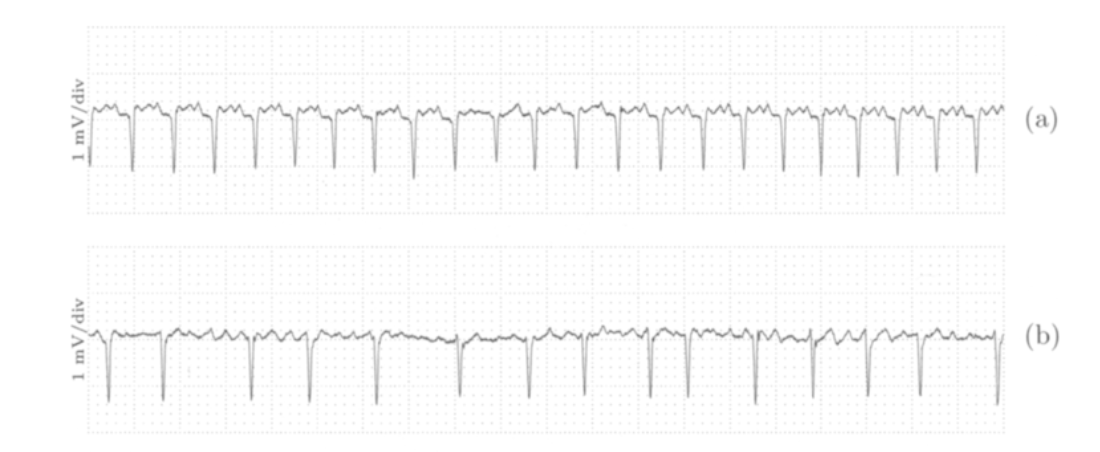 atrial_tachyarrhythmias