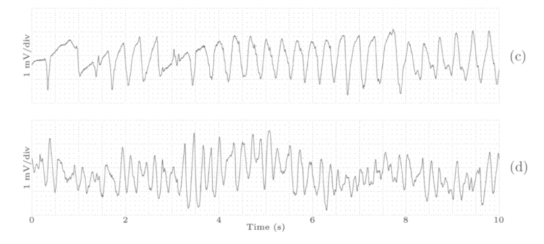 ventricular_tachyarrhythmias